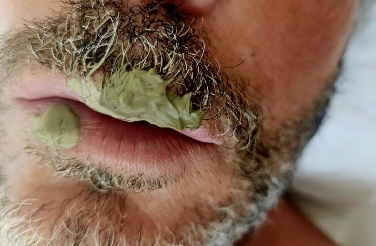Herpes labiale. Rimedio con argilla verde